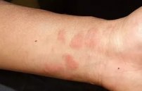 Аллергия от глистов: проявления гельминтов у взрослых