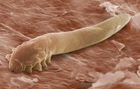 Подкожные паразиты у человека: симптомы и фото червей под кожей