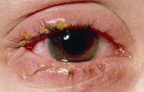 Паразиты в глазах человека симптомы и лечение в домашних условиях