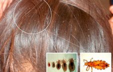 Паразиты в волосах человека на голове: как избавиться от заболевания