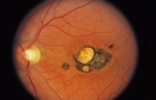 Токсоплазмоз глаз: симптомы и признаки, лечение