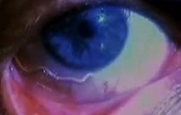 Глисты в глазах человека: симптомы и фото червей