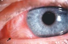 Глазной токсокароз: симптомы, лечение и фото токсокар в глазах