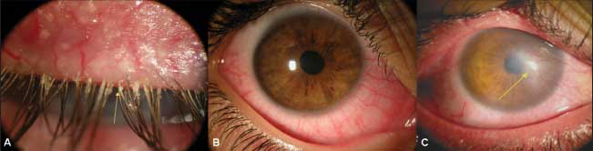 Лечение глазного клеща в домашних условиях
