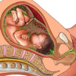 Заражение уреаплазмой в период беременности