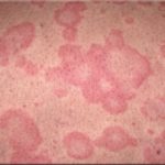 Как проявляет себя аллергия при паразитозах
