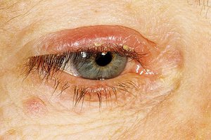 Комплексное лечение демодекса глаз