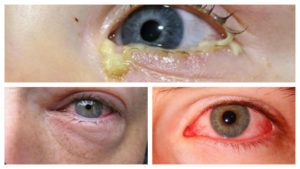 Паразиты в глазах человека симптомы и лечение в домашних условиях