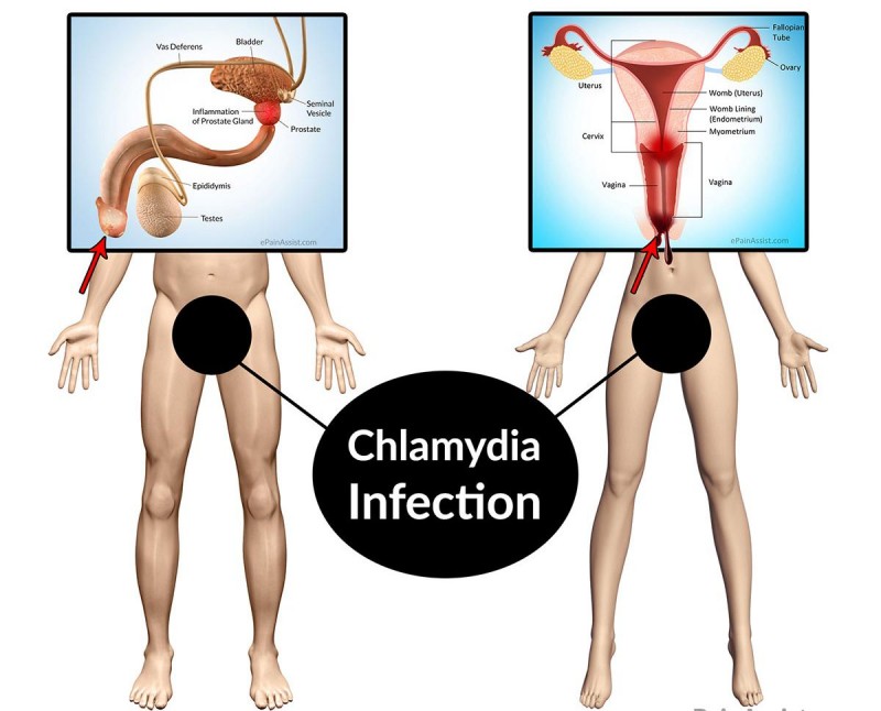 Причины перехода хламидиоза у женщин в хроническую форму и тактика терапии