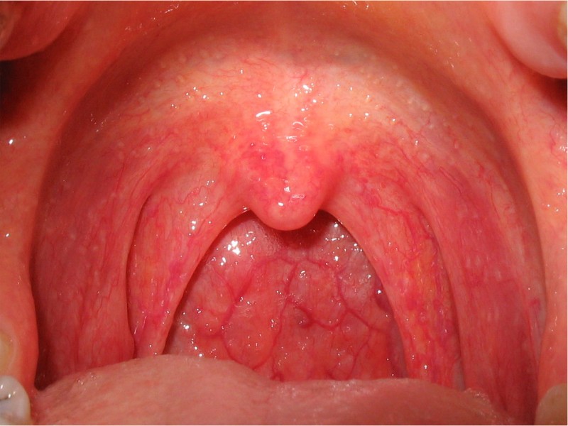 Причины и симптомы хламидиоза горла
