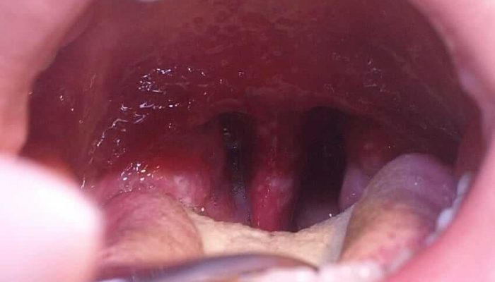 Причины и симптомы хламидиоза горла