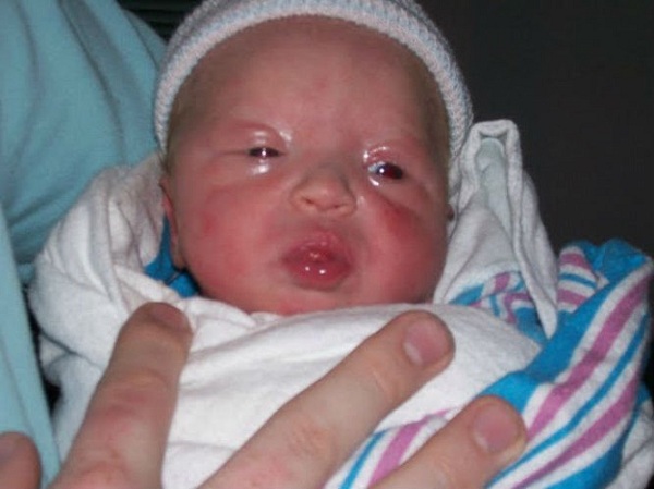 Врожденный токсоплазмоз у новорожденных детей лечение, диагностика, признаки, причины, симптомы